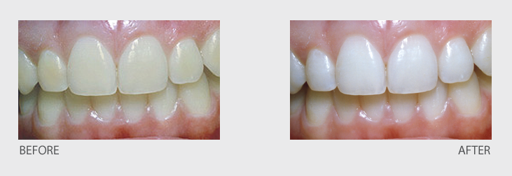 Transparent Teeth Teeth whitening